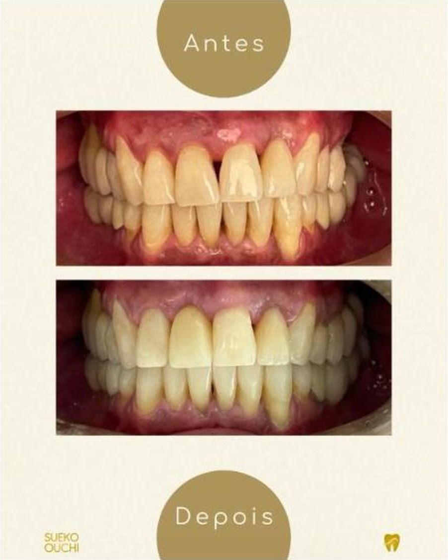 Antes e depois de caso de reabilitação oral